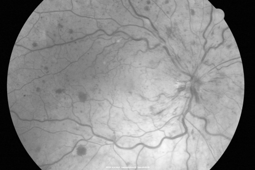 Central Retinal Vein Occlusion Recurrent Edema 6 weeks after Lucentis - Nonperfusion Temporally
66-year-old woman has a central retinal vein occlusion in the right eye with macular edema.  She had intravitreal Lucentis treatment six weeks ago and she has noticed over the last week or two her vision is declining.
 
VISUAL ACUITY:  OD 20/70, OS 20/30.  
