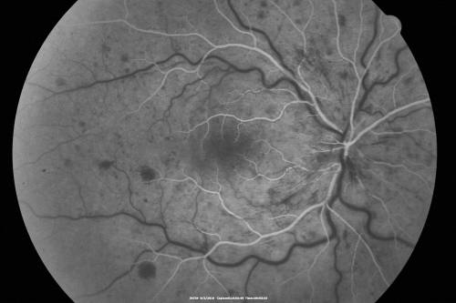 Central Retinal Vein Occlusion Recurrent Edema 6 weeks after Lucentis - Nonperfusion Temporally
66-year-old woman has a central retinal vein occlusion in the right eye with macular edema.  She had intravitreal Lucentis treatment six weeks ago and she has noticed over the last week or two her vision is declining.
 
VISUAL ACUITY:  OD 20/70, OS 20/30.  
