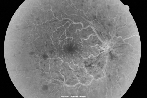 Central Retinal Vein Occlusion Recurrent Edema 6 weeks after Lucentis - Nonperfusion Temporally
66-year-old woman has a central retinal vein occlusion in the right eye with macular edema.  She had intravitreal Lucentis treatment six weeks ago and she has noticed over the last week or two her vision is declining.
 
VISUAL ACUITY:  OD 20/70, OS 20/30.  

