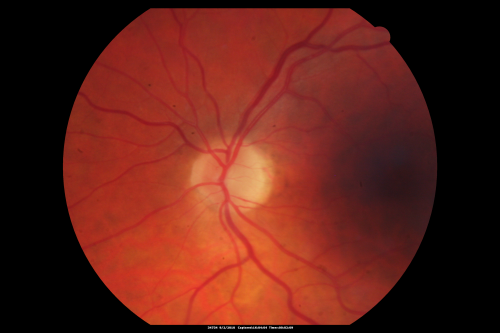 Central Retinal Vein Occlusion Recurrent Edema 6 weeks after Lucentis - Nonperfusion Temporally
66-year-old woman has a central retinal vein occlusion in the right eye with macular edema.  She had intravitreal Lucentis treatment six weeks ago and she has noticed over the last week or two her vision is declining.
 
VISUAL ACUITY:  OD 20/70, OS 20/30.  
