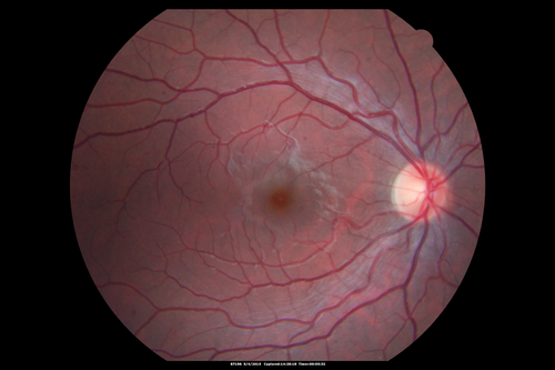 CRVO 25 year old man - Heterozygous Factor V Leiden
20/100 initial vision.  Improved to 20/30 with Lucentis which continued for 3 years, treat and extend, and stopped.
