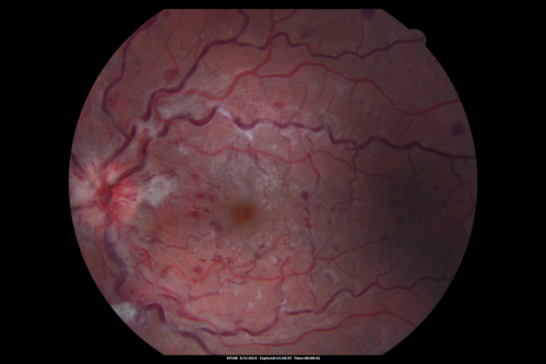 CRVO 25 year old man - Heterozygous Factor V Leiden
20/100 initial vision.  Improved to 20/30 with Lucentis which continued for 3 years, treat and extend, and stopped.
