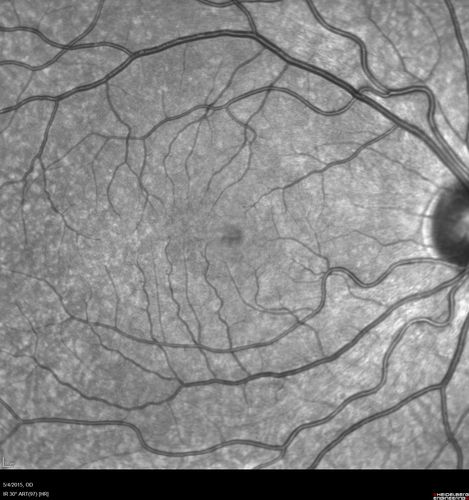CRVO 25 year old man - Heterozygous Factor V Leiden
20/100 initial vision.  Improved to 20/30 with Lucentis which continued for 3 years, treat and extend, and stopped.
