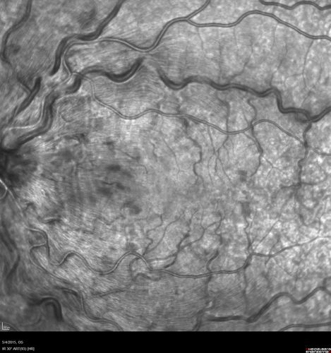 CRVO 25 year old man - Heterozygous Factor V Leiden
20/100 initial vision.  Improved to 20/30 with Lucentis which continued for 3 years, treat and extend, and stopped.

