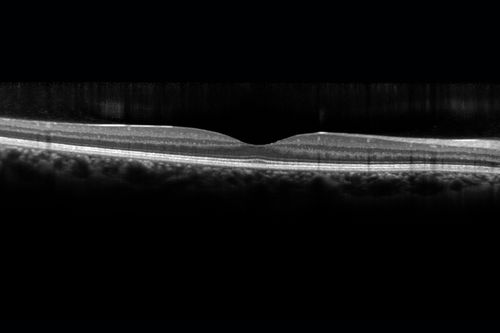 CRVO 25 year old man - Heterozygous Factor V Leiden
20/100 initial vision.  Improved to 20/30 with Lucentis which continued for 3 years, treat and extend, and stopped.
