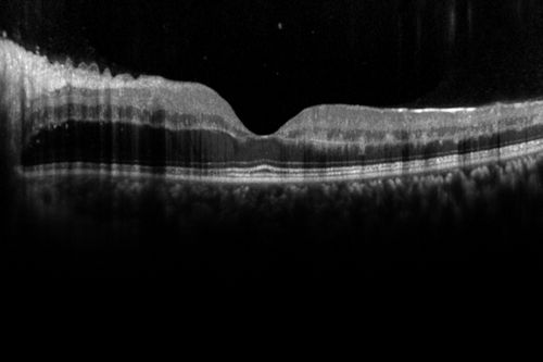 CRVO 25 year old man - Heterozygous Factor V Leiden
20/100 initial vision.  Improved to 20/30 with Lucentis which continued for 3 years, treat and extend, and stopped.
