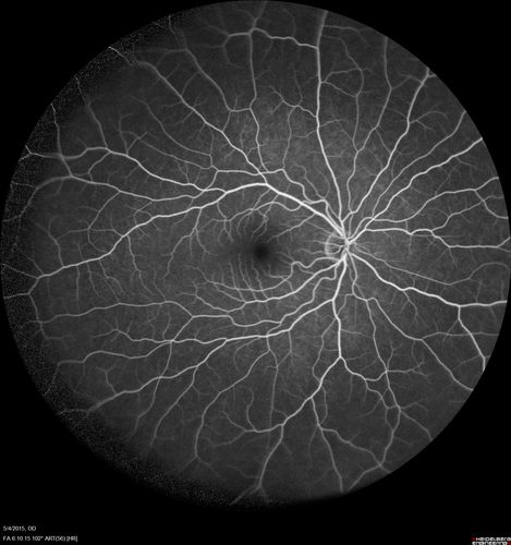 CRVO 25 year old man - Heterozygous Factor V Leiden
20/100 initial vision.  Improved to 20/30 with Lucentis which continued for 3 years, treat and extend, and stopped.
