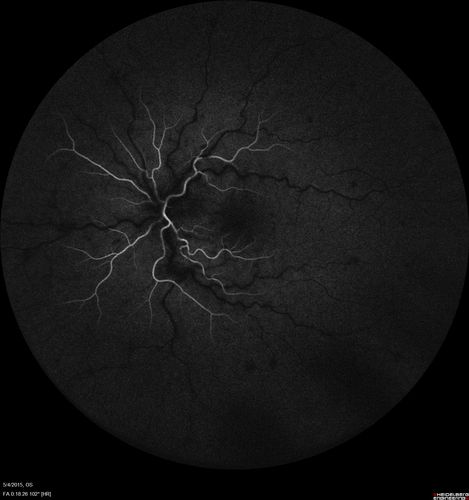 CRVO 25 year old man - Heterozygous Factor V Leiden
20/100 initial vision.  Improved to 20/30 with Lucentis which continued for 3 years, treat and extend, and stopped.
