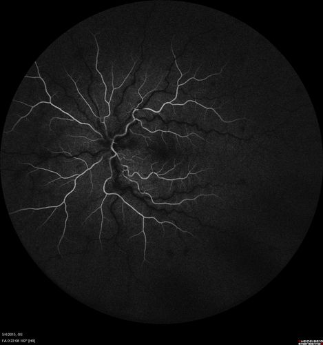 CRVO 25 year old man - Heterozygous Factor V Leiden
20/100 initial vision.  Improved to 20/30 with Lucentis which continued for 3 years, treat and extend, and stopped.
