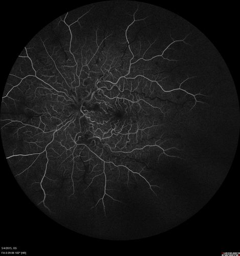 CRVO 25 year old man - Heterozygous Factor V Leiden
20/100 initial vision.  Improved to 20/30 with Lucentis which continued for 3 years, treat and extend, and stopped.
