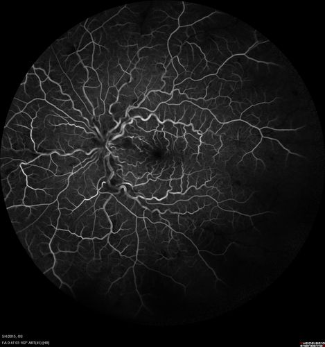 CRVO 25 year old man - Heterozygous Factor V Leiden
20/100 initial vision.  Improved to 20/30 with Lucentis which continued for 3 years, treat and extend, and stopped.
