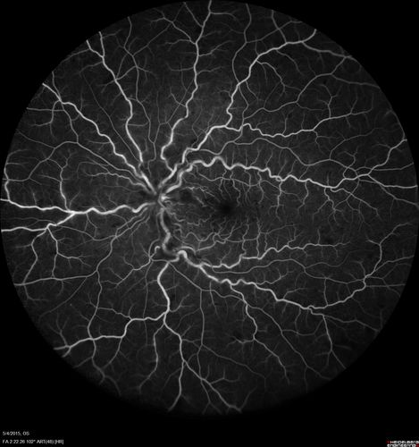 CRVO 25 year old man - Heterozygous Factor V Leiden
20/100 initial vision.  Improved to 20/30 with Lucentis which continued for 3 years, treat and extend, and stopped.
