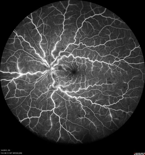 CRVO 25 year old man - Heterozygous Factor V Leiden
20/100 initial vision.  Improved to 20/30 with Lucentis which continued for 3 years, treat and extend, and stopped.
