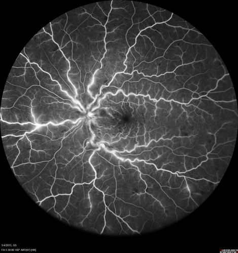 CRVO 25 year old man - Heterozygous Factor V Leiden
20/100 initial vision.  Improved to 20/30 with Lucentis which continued for 3 years, treat and extend, and stopped.
