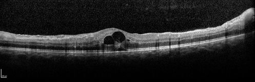 Mtehylenetetrahydrofolate reductase c677T homozygous CRVO pregnant woman (MTHFR)
Vision improved from 20/50 to 20/16 in one month following ozurdex injections.  38 year old woman with only one eye.  The left eye was removed as a child for retinoblastoma.
