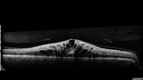 Non-ischemic Central Retinal Vein Occlusion with Macular Edema
62 year old man The vision in the right eye started to decline about 10 days ago.  Prior to that the two eyes were about the same.  
VA OD: Dcc20/125 PH20/50-2
VA OS: Dcc20/20
IOP: TP: OD:21 OS:21
