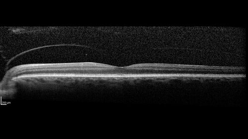 Non-ischemic Central Retinal Vein Occlusion with Macular Edema
62 year old man The vision in the right eye started to decline about 10 days ago.  Prior to that the two eyes were about the same.  
VA OD: Dcc20/125 PH20/50-2
VA OS: Dcc20/20
IOP: TP: OD:21 OS:21

