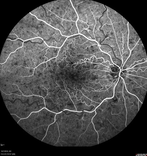Non-ischemic Central Retinal Vein Occlusion with Macular Edema
62 year old man The vision in the right eye started to decline about 10 days ago.  Prior to that the two eyes were about the same.  
VA OD: Dcc20/125 PH20/50-2
VA OS: Dcc20/20
IOP: TP: OD:21 OS:21
