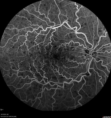 Non-ischemic Central Retinal Vein Occlusion with Macular Edema
62 year old man The vision in the right eye started to decline about 10 days ago.  Prior to that the two eyes were about the same.  
VA OD: Dcc20/125 PH20/50-2
VA OS: Dcc20/20
IOP: TP: OD:21 OS:21
