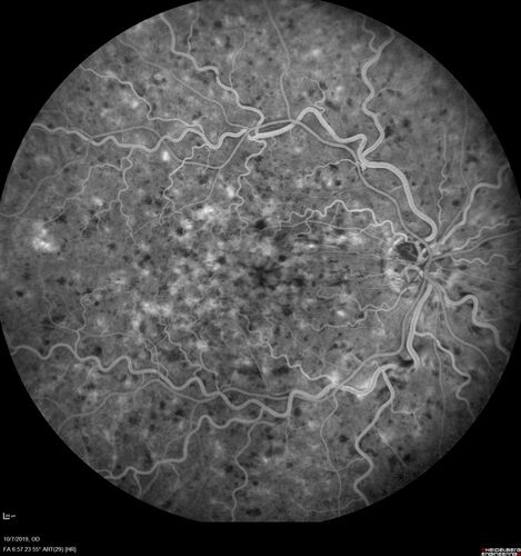 Non-ischemic Central Retinal Vein Occlusion with Macular Edema
62 year old man The vision in the right eye started to decline about 10 days ago.  Prior to that the two eyes were about the same.  
VA OD: Dcc20/125 PH20/50-2
VA OS: Dcc20/20
IOP: TP: OD:21 OS:21
