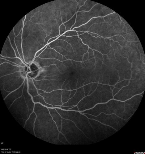 Non-ischemic Central Retinal Vein Occlusion with Macular Edema
62 year old man The vision in the right eye started to decline about 10 days ago.  Prior to that the two eyes were about the same.  
VA OD: Dcc20/125 PH20/50-2
VA OS: Dcc20/20
IOP: TP: OD:21 OS:21
