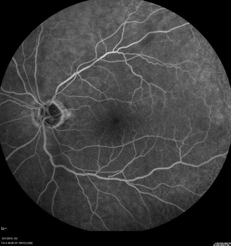 Non-ischemic Central Retinal Vein Occlusion with Macular Edema
62 year old man The vision in the right eye started to decline about 10 days ago.  Prior to that the two eyes were about the same.  
VA OD: Dcc20/125 PH20/50-2
VA OS: Dcc20/20
IOP: TP: OD:21 OS:21
