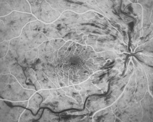 49-year-old woman has central retinal vein occlusion right eye with fluctuating vision for a few month now with  OD 20/100.  IOP: OD 20
