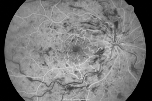 49-year-old woman has central retinal vein occlusion right eye with fluctuating vision for a few month now with  OD 20/100.  IOP: OD 20
