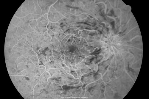 49-year-old woman has central retinal vein occlusion right eye with fluctuating vision for a few month now with  OD 20/100.  IOP: OD 20
