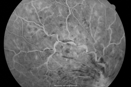 49-year-old woman has central retinal vein occlusion right eye with fluctuating vision for a few month now with  OD 20/100.  IOP: OD 20
