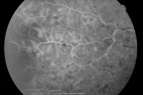 49-year-old woman has central retinal vein occlusion right eye with fluctuating vision for a few month now with  OD 20/100.  IOP: OD 20
