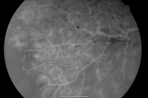 49-year-old woman has central retinal vein occlusion right eye with fluctuating vision for a few month now with  OD 20/100.  IOP: OD 20
