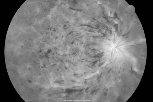 49-year-old woman has central retinal vein occlusion right eye with fluctuating vision for a few month now with  OD 20/100.  IOP: OD 20

