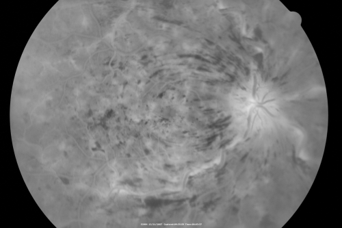 49-year-old woman has central retinal vein occlusion right eye with fluctuating vision for a few month now with  OD 20/100.  IOP: OD 20

