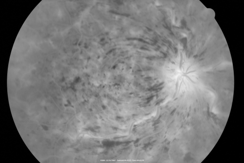 49-year-old woman has central retinal vein occlusion right eye with fluctuating vision for a few month now with  OD 20/100.  IOP: OD 20
