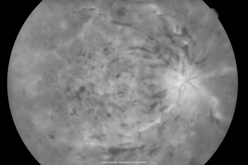 49-year-old woman has central retinal vein occlusion right eye with fluctuating vision for a few month now with  OD 20/100.  IOP: OD 20
