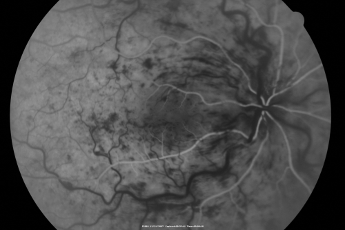 49-year-old woman has central retinal vein occlusion right eye with fluctuating vision for a few month now with  OD 20/100.  IOP: OD 20

