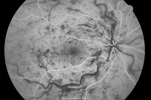49-year-old woman has central retinal vein occlusion right eye with fluctuating vision for a few month now with  OD 20/100.  IOP: OD 20

