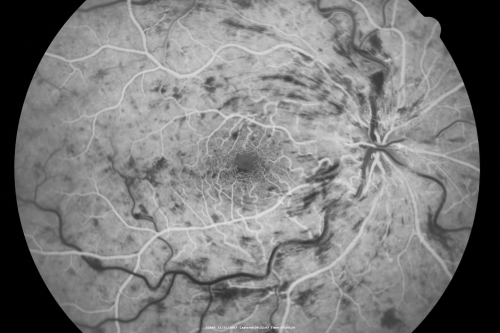 49-year-old woman has central retinal vein occlusion right eye with fluctuating vision for a few month now with  OD 20/100.  IOP: OD 20
