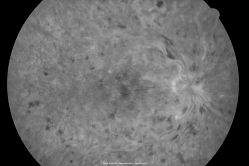 Central Retinal Vein Occlusion and Cystoid Macular Edema - Acute - Vision 20/50 
68-year-old man  six weeks of vision loss right eye from CRVO and CME, vision right eye 20/50
Keywords: crvo;cme;foveal cyst
