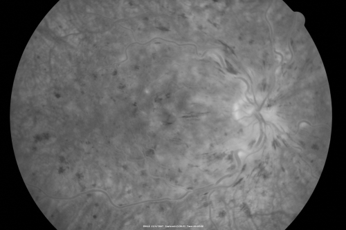 Central Retinal Vein Occlusion and Cystoid Macular Edema - Acute - Vision 20/50 
68-year-old man  six weeks of vision loss right eye from CRVO and CME, vision right eye 20/50
Palabras clave: crvo;cme;foveal cyst