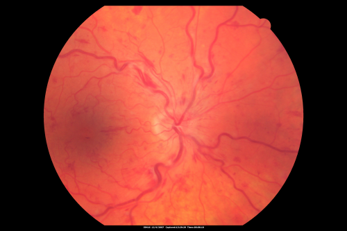 Central Retinal Vein Occlusion and Cystoid Macular Edema - Acute - Vision 20/50 
68-year-old man  six weeks of vision loss right eye from CRVO and CME, vision right eye 20/50
Keywords: crvo;cme;foveal cyst