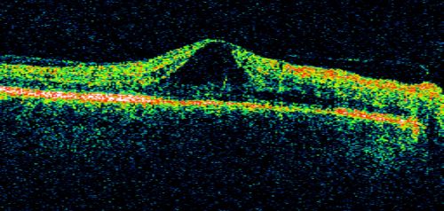 Central Retinal Vein Occlusion and Cystoid Macular Edema - Acute - Vision 20/50 
68-year-old man  six weeks of vision loss right eye from CRVO and CME, vision right eye 20/50
Keywords: crvo;cme;foveal cyst