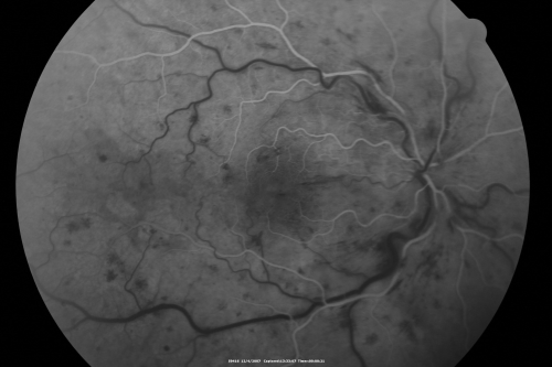 Central Retinal Vein Occlusion and Cystoid Macular Edema - Acute - Vision 20/50 
68-year-old man  six weeks of vision loss right eye from CRVO and CME, vision right eye 20/50
Keywords: crvo;cme;foveal cyst