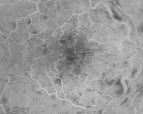 Central Retinal Vein Occlusion and Cystoid Macular Edema - Acute - Vision 20/50 
68-year-old man  six weeks of vision loss right eye from CRVO and CME, vision right eye 20/50
Keywords: crvo;cme;foveal cyst