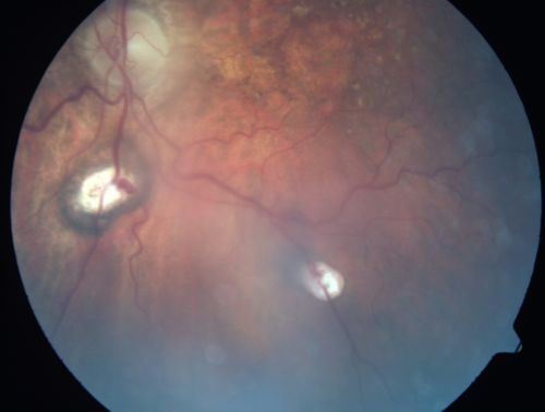 Central Retinal Vein Occlusion and Laser Induced Chorioretinal Anastomosis
84-year-old woman has age-related macular degeneration in both eyes with foveal atrophy.  She also has a central retinal vein occlusion 
in the left eye for which she had intravitreal Kenalog and finally chorioretinal anastomosis laser a year 
ago.  VISUAL ACUITY:  Vision OD is 20/160, OS is 7/200
