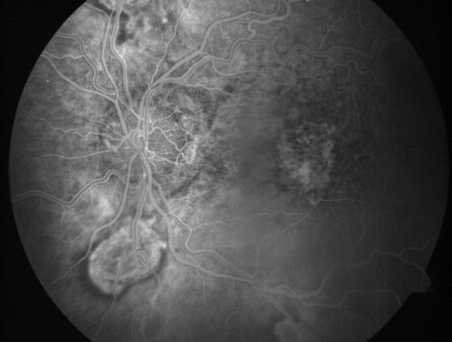 Central Retinal Vein Occlusion and Laser Induced Chorioretinal Anastomosis
84-year-old woman has age-related macular degeneration in both eyes with foveal atrophy.  She also has a central retinal vein occlusion 
in the left eye for which she had intravitreal Kenalog and finally chorioretinal anastomosis laser a year 
ago.  VISUAL ACUITY:  Vision OD is 20/160, OS is 7/200
