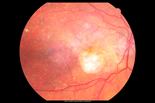 Central Retinal Vein Occlusion - New- and old Macular Scar from AMD
87-year-old woman with longstaning macular scars and new vision loss left eye for 2 months. OD:  20/200, OS 20/400. 
