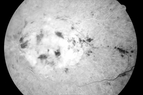 Central Retinal Vein Occlusion - New- and old Macular Scar from AMD
87-year-old woman with longstaning macular scars and new vision loss left eye for 2 months. OD:  20/200, OS 20/400. 

