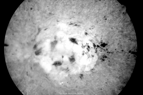 Central Retinal Vein Occlusion - New- and old Macular Scar from AMD
87-year-old woman with longstaning macular scars and new vision loss left eye for 2 months. OD:  20/200, OS 20/400. 
